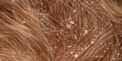 Trichorrhexis Nodosa